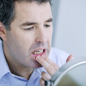 טיפול באפטות בחניכיים